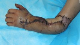 150724171136-xiangya-hospital-severed-hand-reattach-12-super-169.jpg